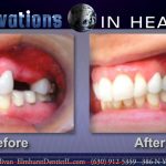 Mini Dental Implants of Illinois - Before and after shots Dr Michael Sullivan