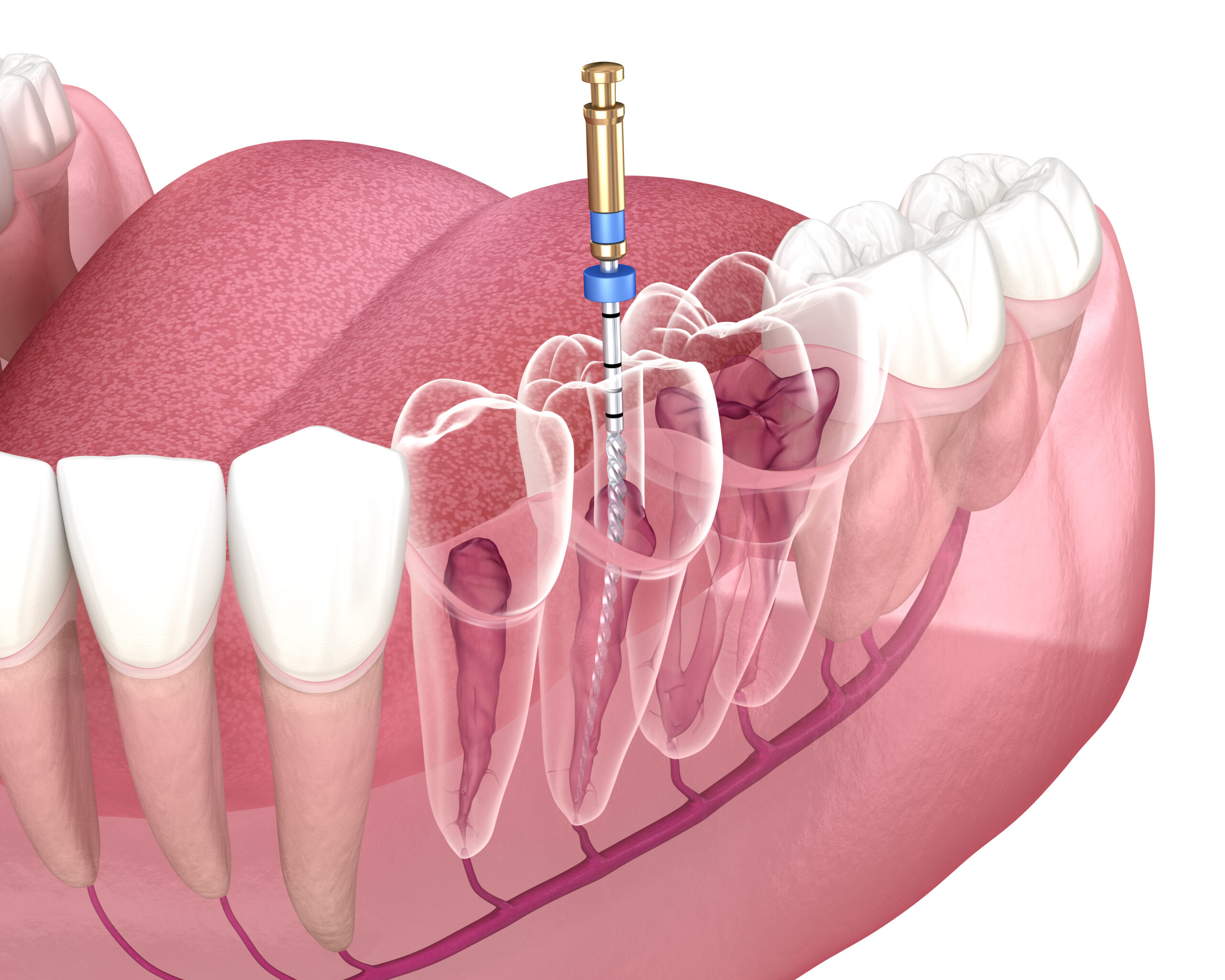 Root Canal Treatment